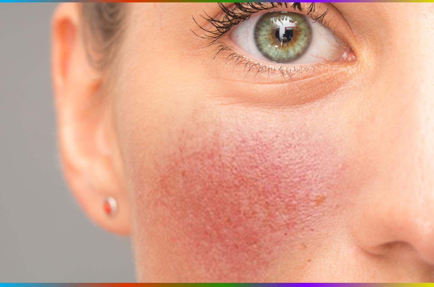 Mitos e verdades sobre rosácea